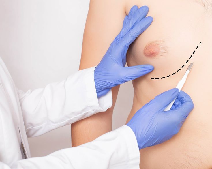 Gynecomastia Gynecomastia image