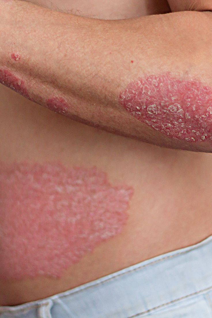 Psoriasis Treatment Psoriasis Treatment image