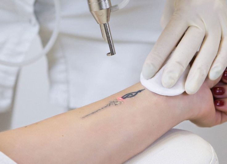 Tattoo Removal Tattoo Removal image