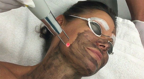Carbon Peel Carbon Peel image