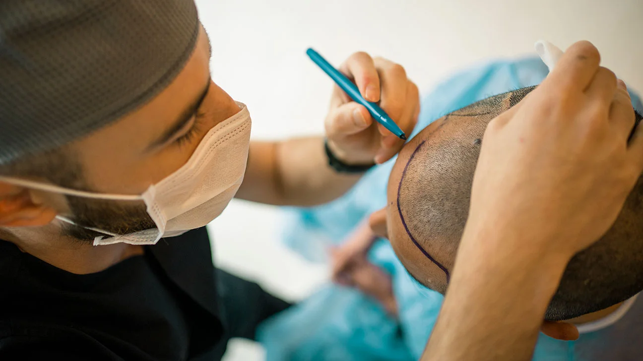 Fut Hair Transplant image