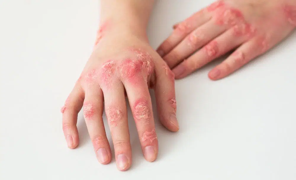 syphilis Treatment syphilis Treatment image