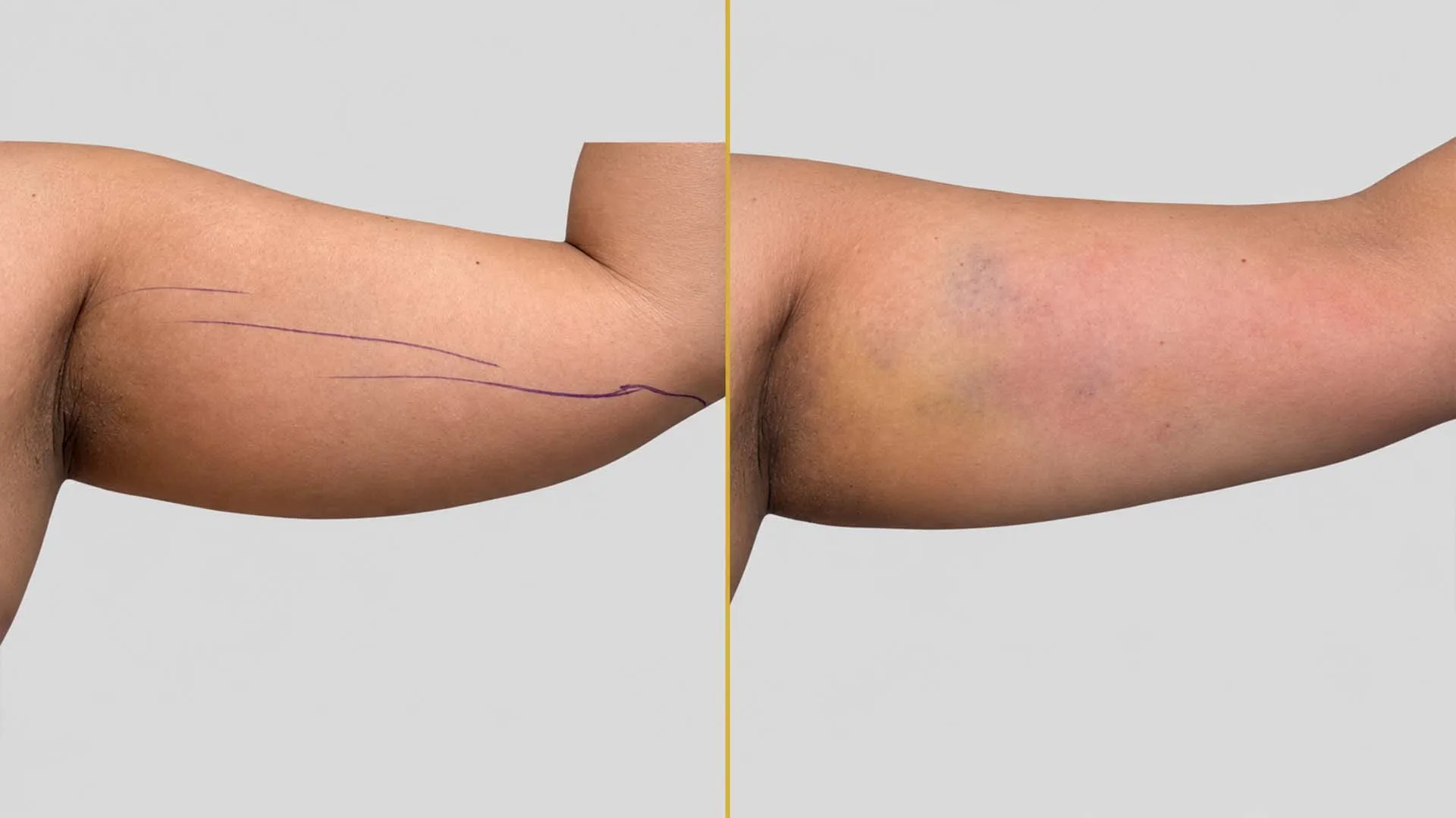 Arm Contouring (Brachioplasty) before and after result - The Hair and Shape Clinic, Mumbai