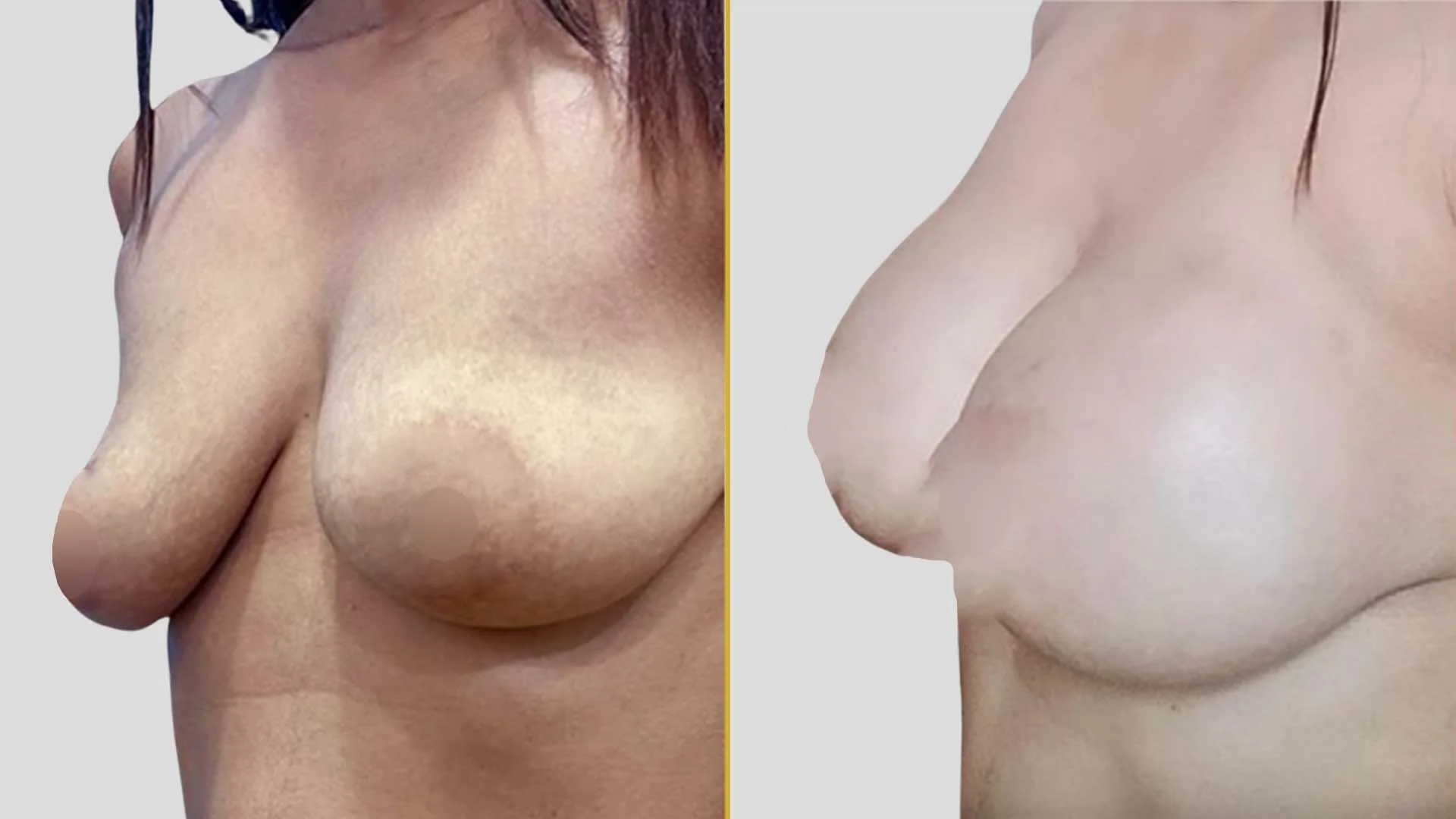 Breast Lift (Mastopexy) before and after result - The Hair and Shape Clinic, Mumbai