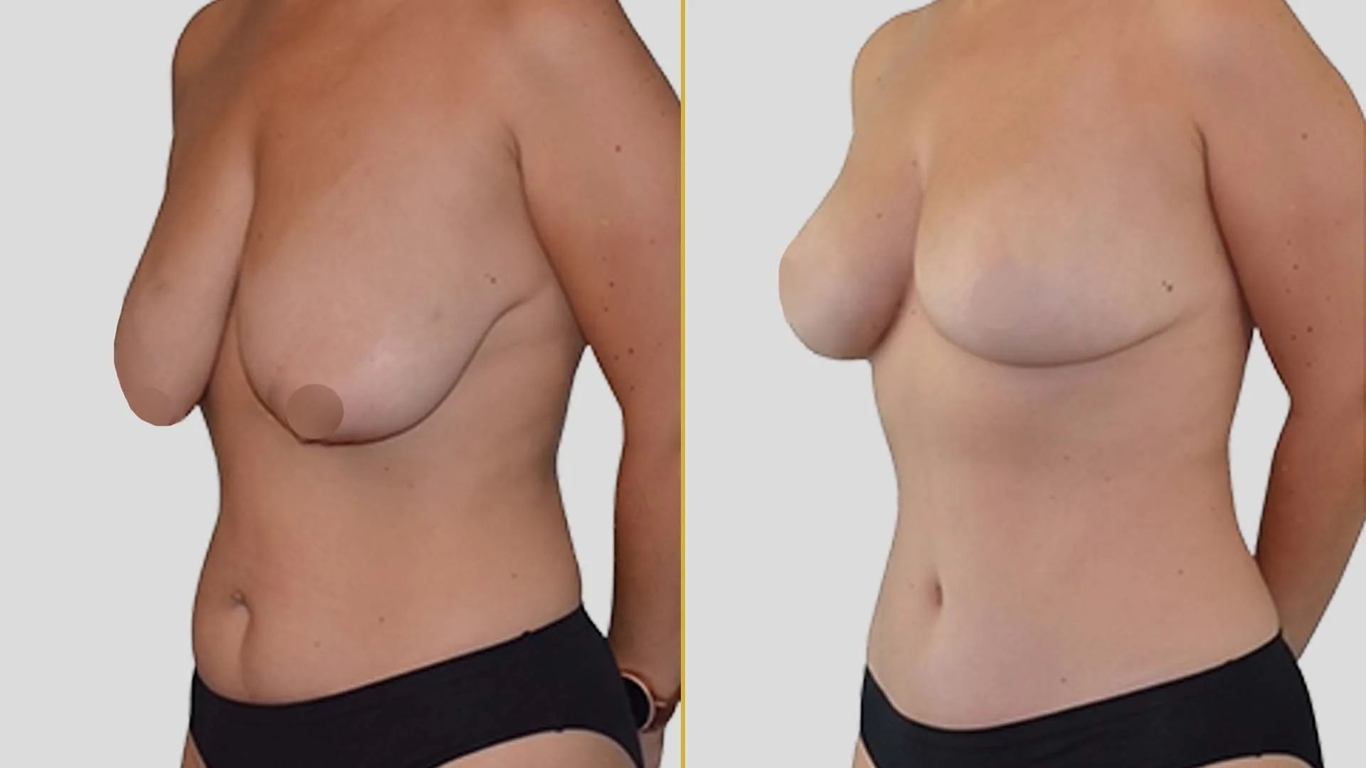 Breast Lift (Mastopexy) before and after result - The Hair and Shape Clinic, Mumbai
