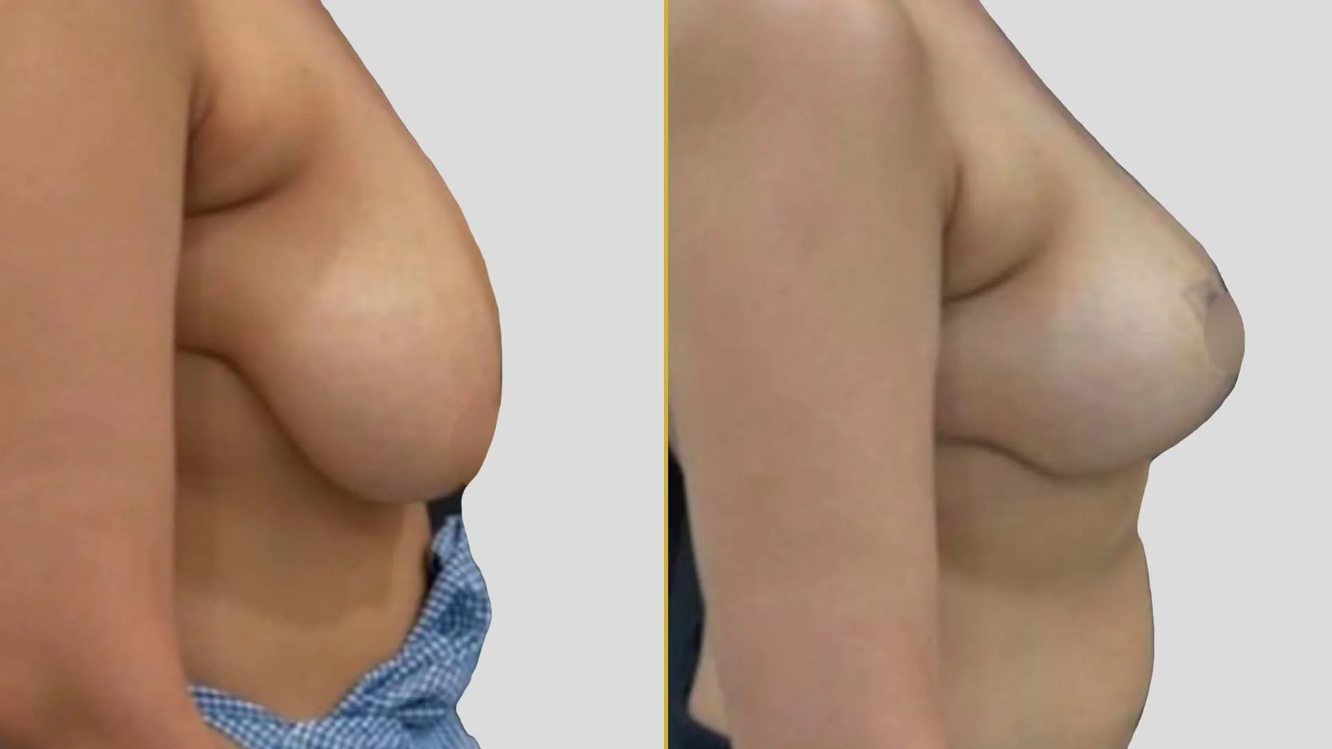 Breast Lift (Mastopexy) before and after result - The Hair and Shape Clinic, Mumbai