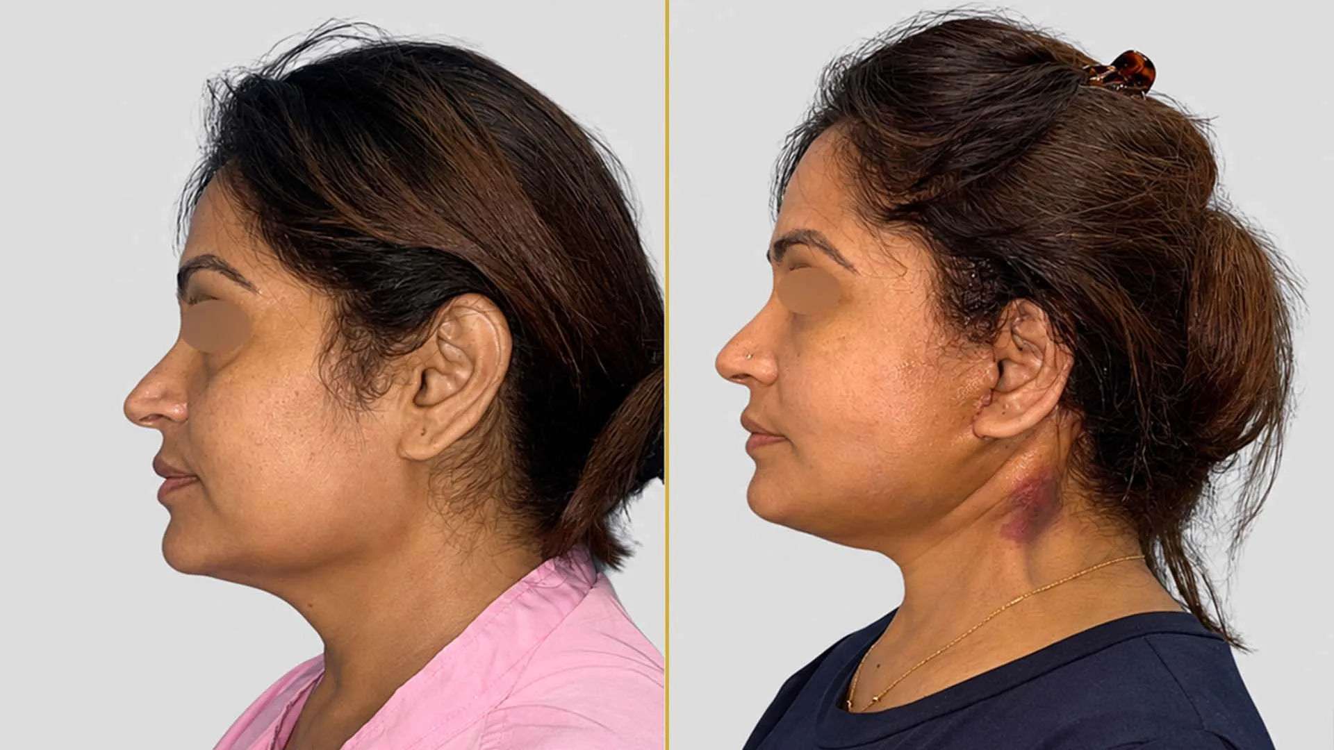 Face Lift before and after result - The Hair and Shape Clinic, Mumbai