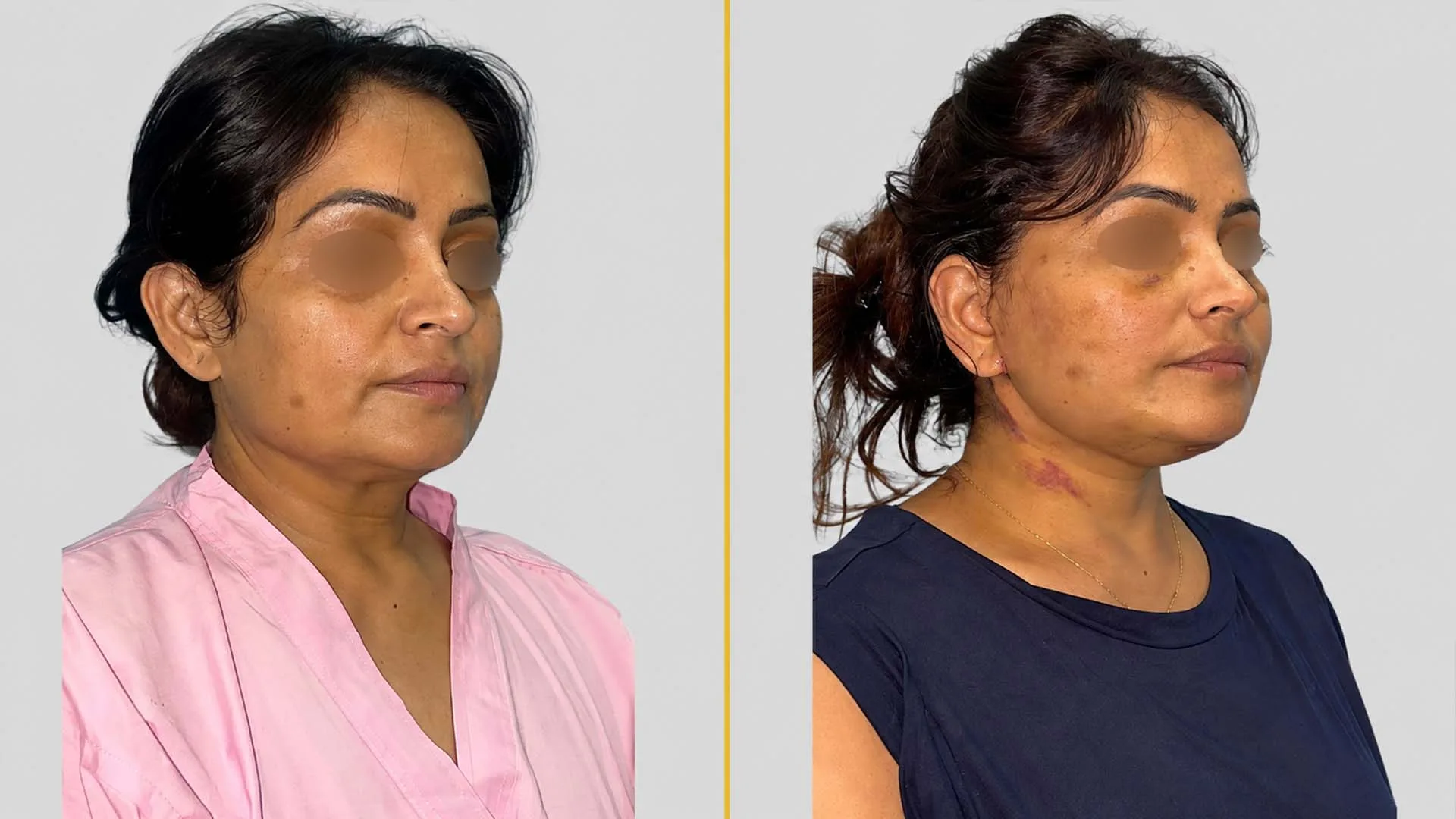 Face Lift before and after result - The Hair and Shape Clinic, Mumbai