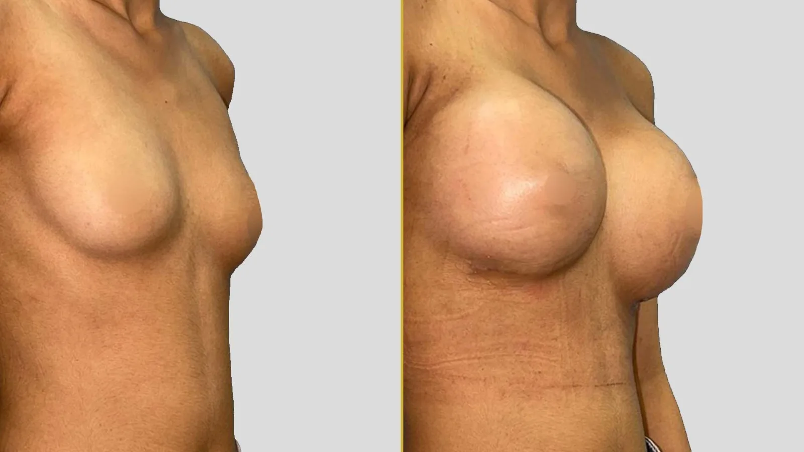 Gender Reassignment before and after result - The Hair and Shape Clinic, Mumbai