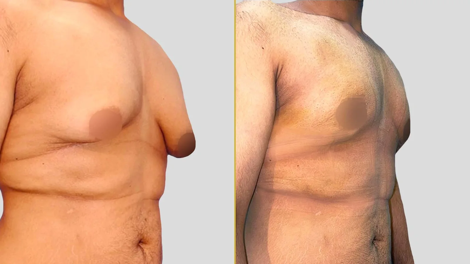 Gender Reassignment before and after result - The Hair and Shape Clinic, Mumbai