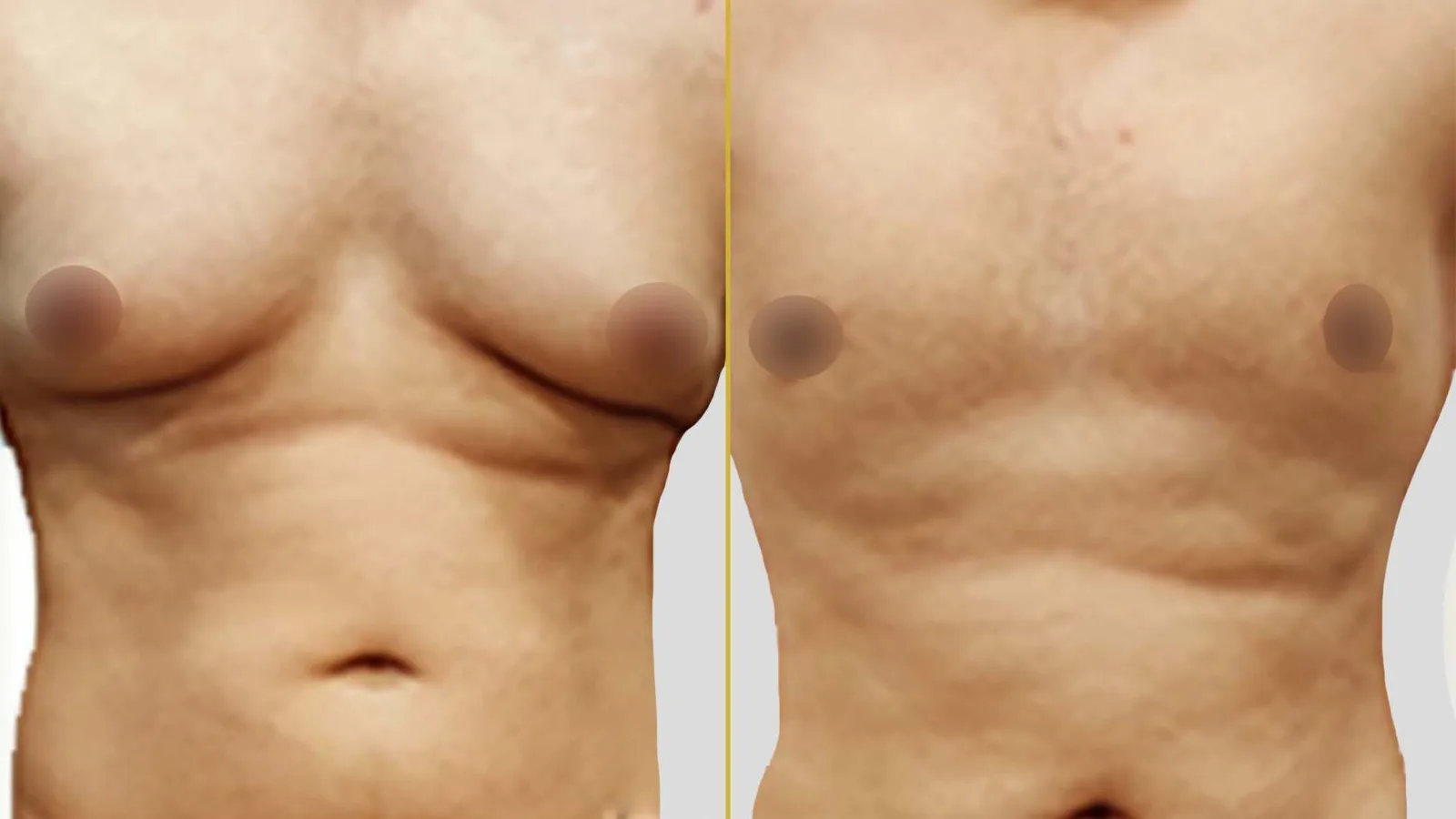 Gender Reassignment before and after result - The Hair and Shape Clinic, Mumbai