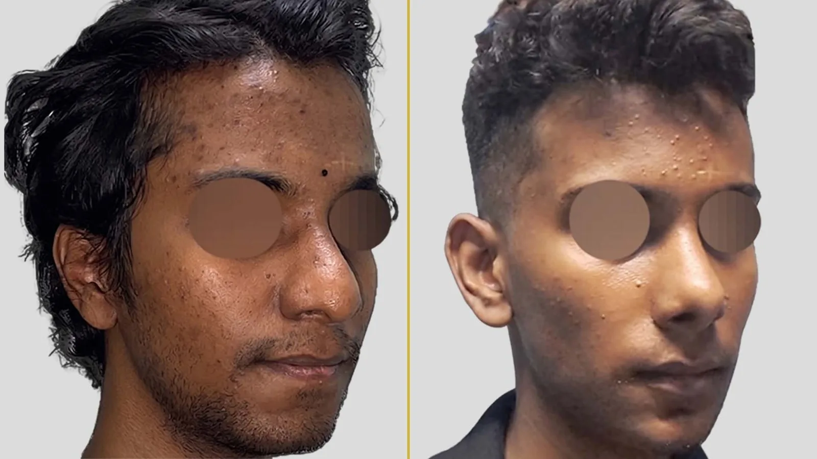 Gender Reassignment before and after result - The Hair and Shape Clinic, Mumbai