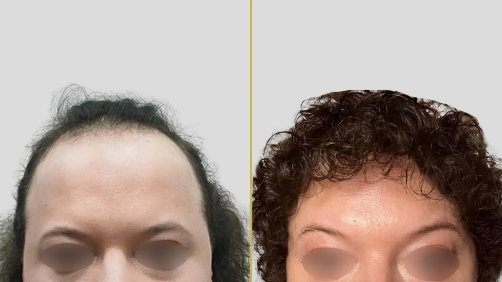 Gender Reassignment before and after result - The Hair and Shape Clinic, Mumbai