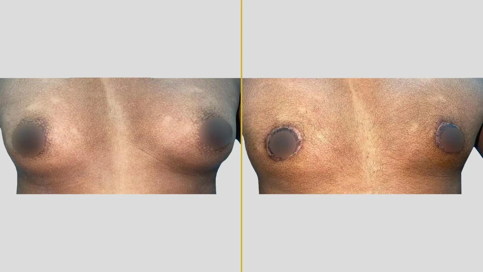 Gender Reassignment before and after result - The Hair and Shape Clinic, Mumbai