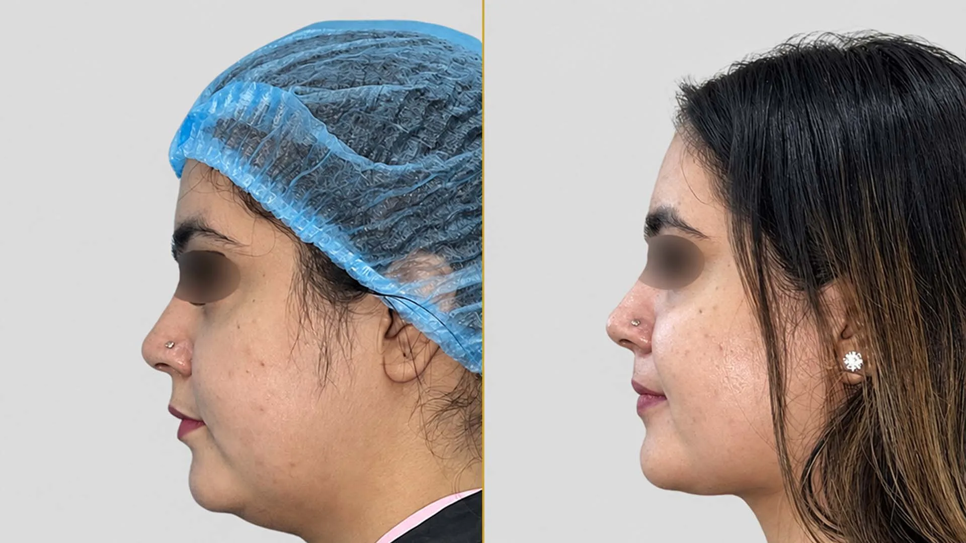 Genioplasty (Chin Surgery) before and after result - The Hair and Shape Clinic, Mumbai