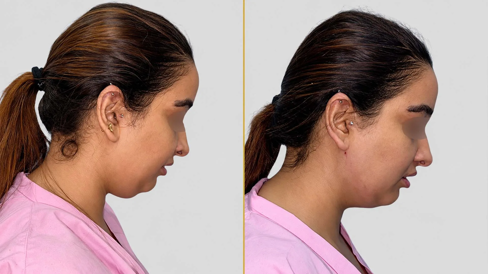 Genioplasty (Chin Surgery) before and after result - The Hair and Shape Clinic, Mumbai