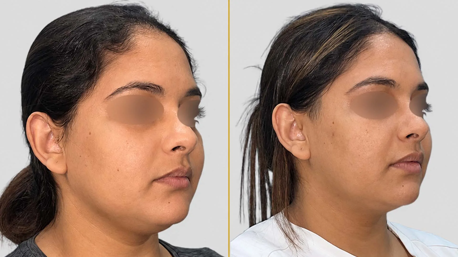 Genioplasty (Chin Surgery) before and after result - The Hair and Shape Clinic, Mumbai