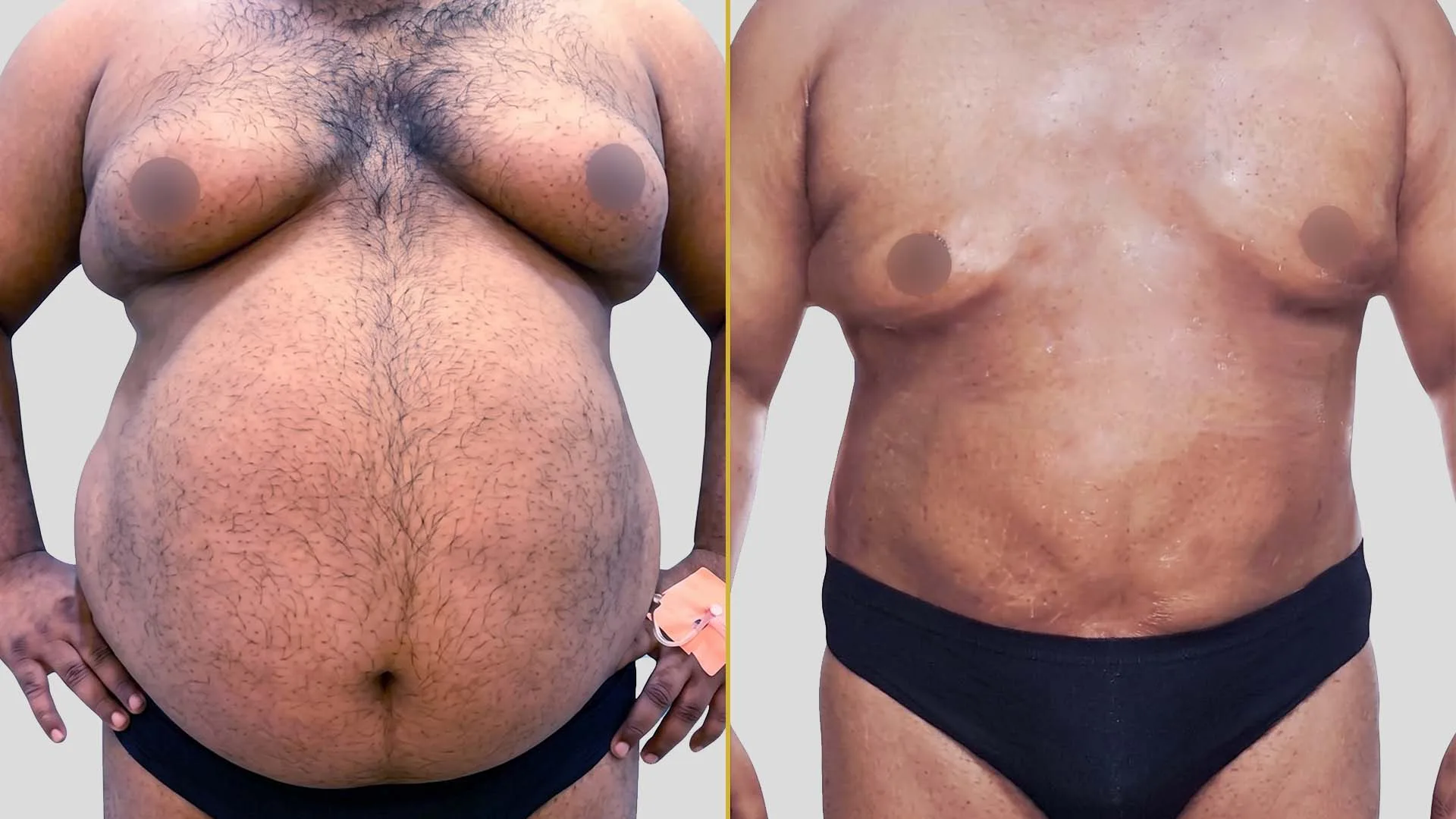 Gynecomastia Treatment before and after result - The Hair and Shape Clinic, Mumbai