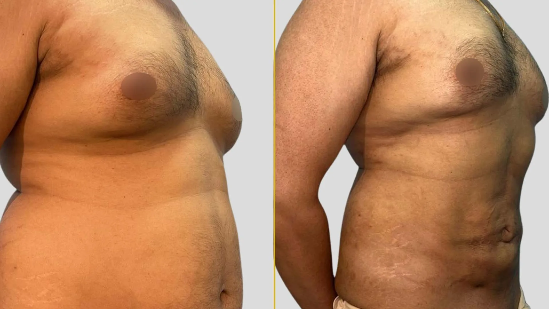 Gynecomastia Treatment before and after result - The Hair and Shape Clinic, Mumbai
