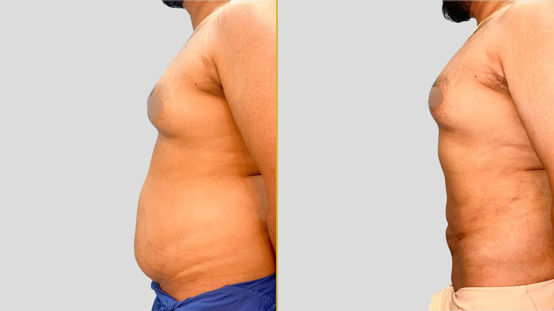 Gynecomastia Treatment before and after result - The Hair and Shape Clinic, Mumbai