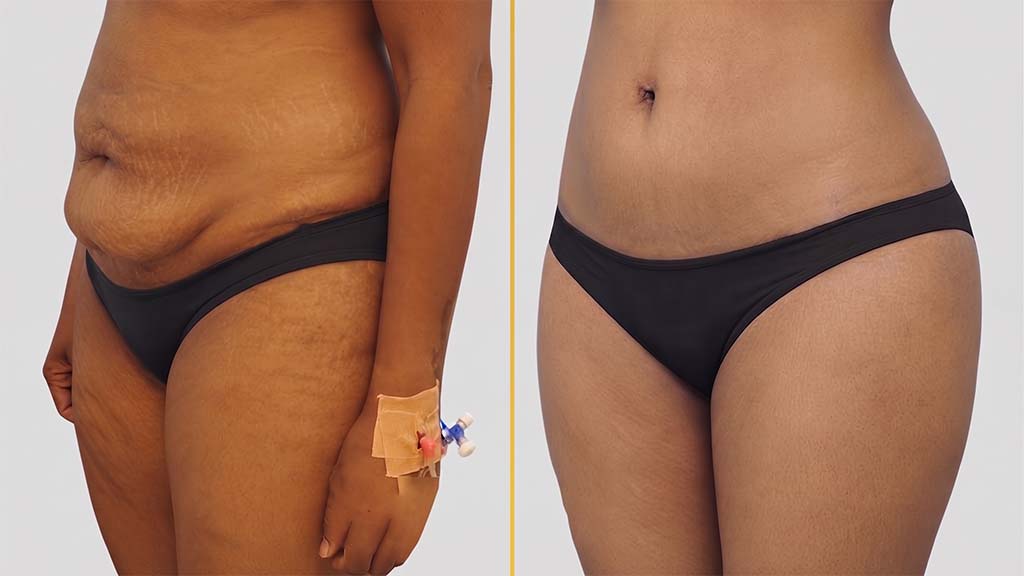 Liposuction before and after result - The Hair and Shape Clinic, Mumbai