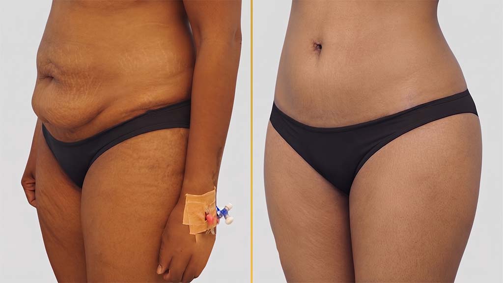Liposuction before and after result - The Hair and Shape Clinic, Mumbai
