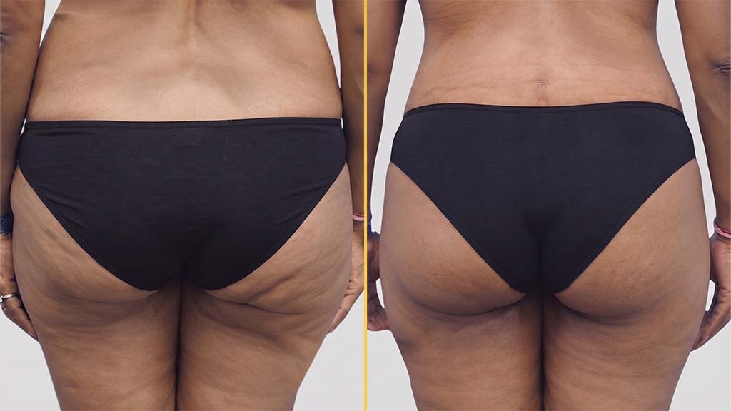 Liposuction before and after result - The Hair and Shape Clinic, Mumbai