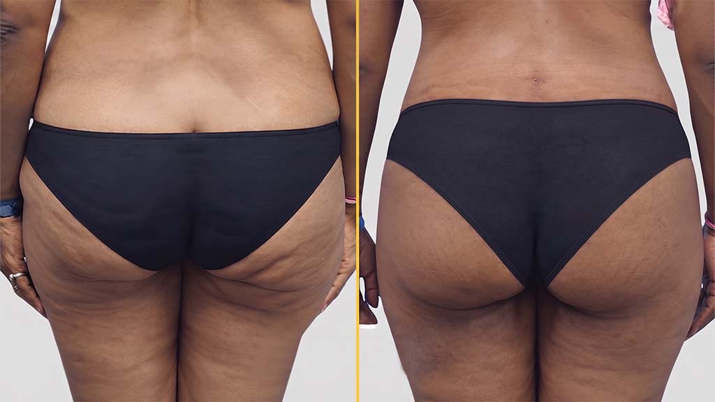 Liposuction before and after result - The Hair and Shape Clinic, Mumbai
