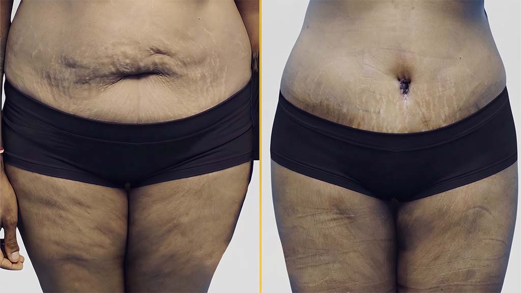 Liposuction before and after result - The Hair and Shape Clinic, Mumbai