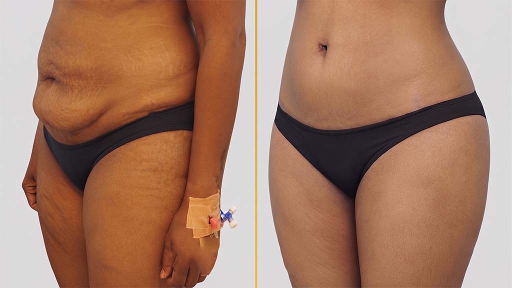 Liposuction before and after result - The Hair and Shape Clinic, Mumbai