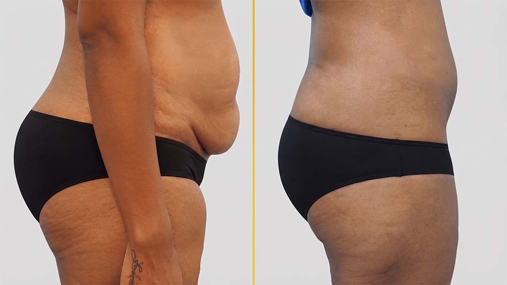 Liposuction before and after result - The Hair and Shape Clinic, Mumbai