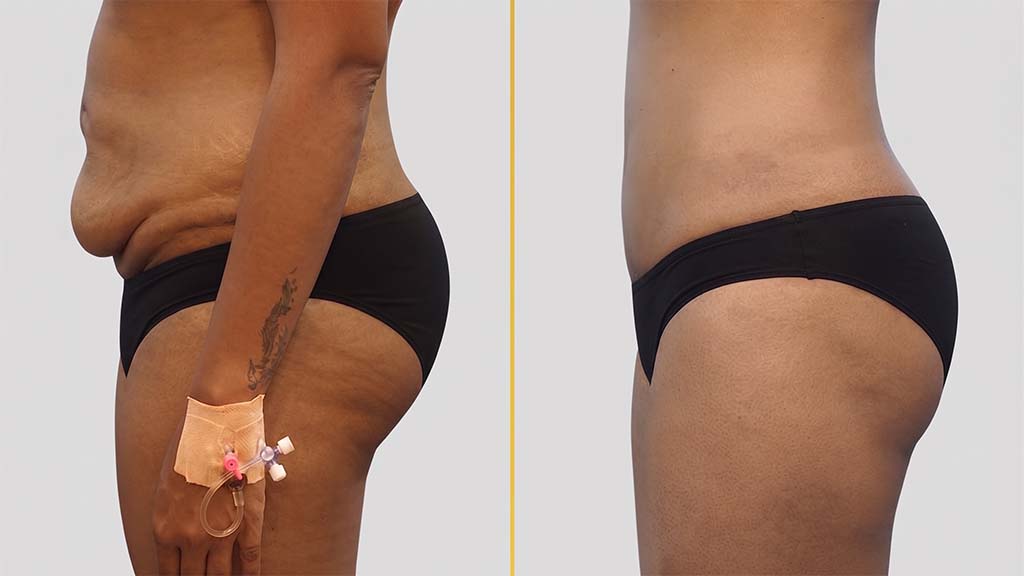 Liposuction before and after result - The Hair and Shape Clinic, Mumbai