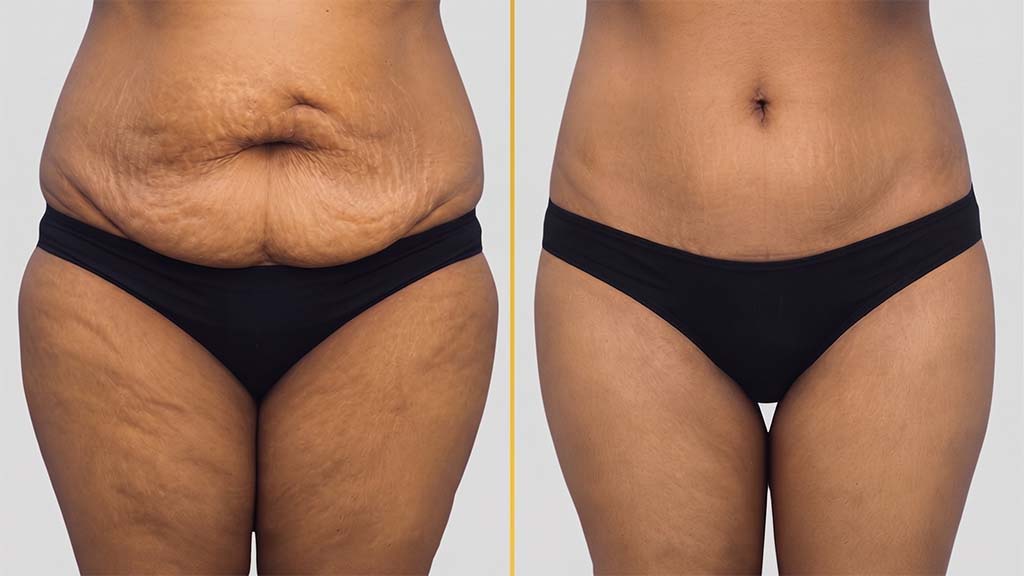 Liposuction before and after result - The Hair and Shape Clinic, Mumbai