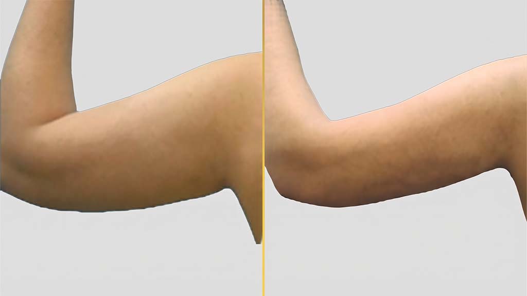Arm Contouring (Brachioplasty) before and after result - The Hair and Shape Clinic, Mumbai