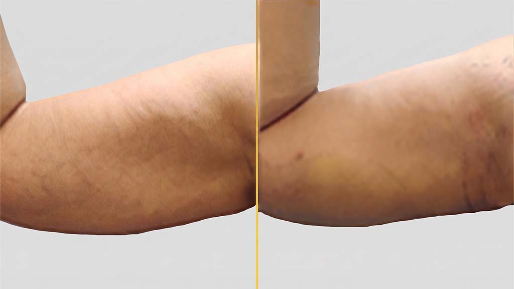 Arm Contouring (Brachioplasty) before and after result - The Hair and Shape Clinic, Mumbai