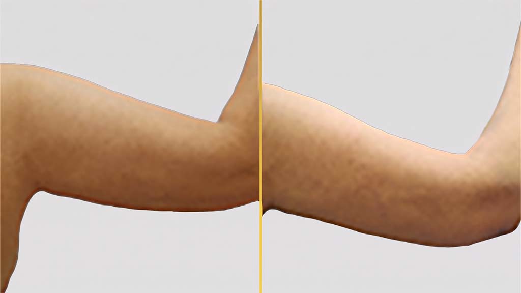 Arm Contouring (Brachioplasty) before and after result - The Hair and Shape Clinic, Mumbai
