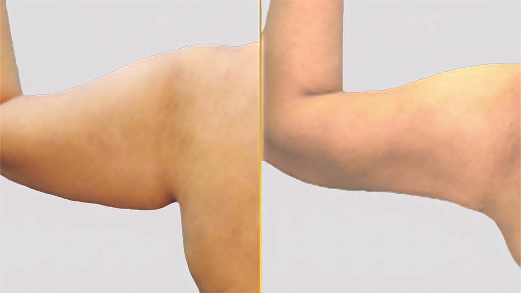 Arm Contouring (Brachioplasty) before and after result - The Hair and Shape Clinic, Mumbai