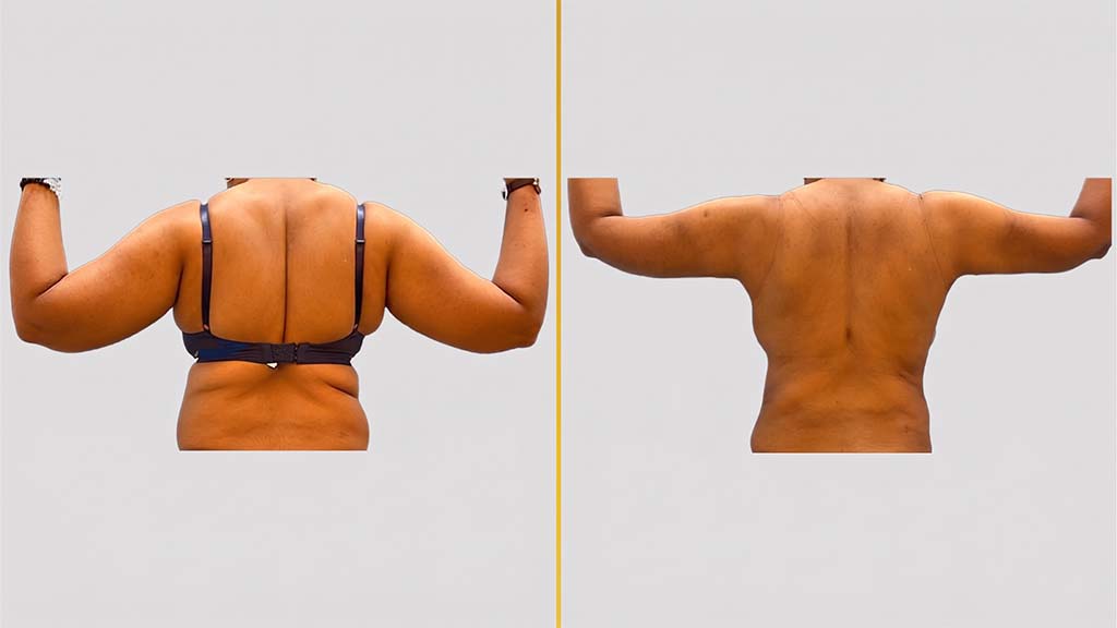 Arm Contouring (Brachioplasty) before and after result - The Hair and Shape Clinic, Mumbai
