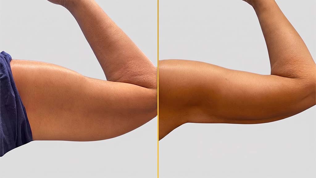 Arm Contouring (Brachioplasty) before and after result - The Hair and Shape Clinic, Mumbai