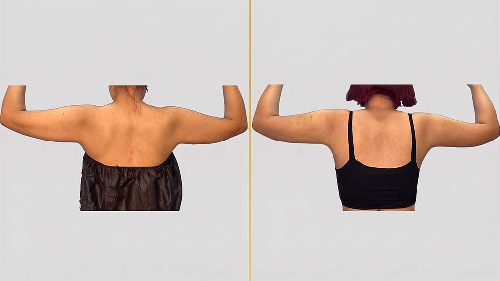 Arm Contouring (Brachioplasty) before and after result - The Hair and Shape Clinic, Mumbai