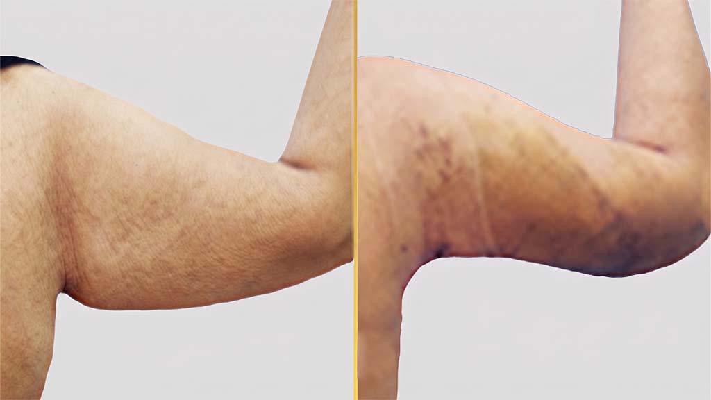 Arm Contouring (Brachioplasty) before and after result - The Hair and Shape Clinic, Mumbai