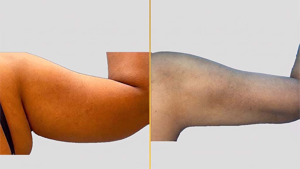 Arm Contouring (Brachioplasty) before and after result - The Hair and Shape Clinic, Mumbai