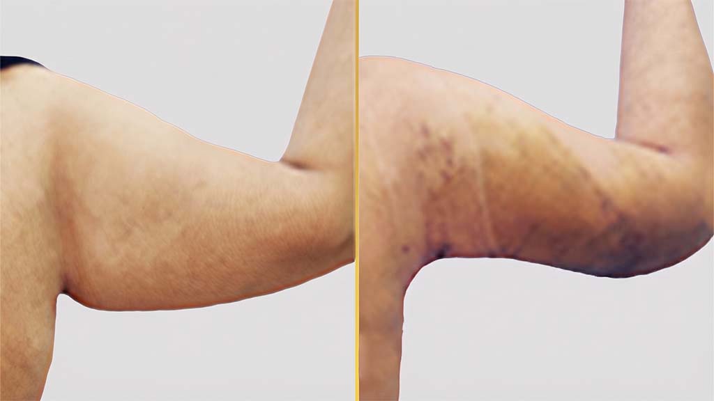 Arm Contouring (Brachioplasty) before and after result - The Hair and Shape Clinic, Mumbai