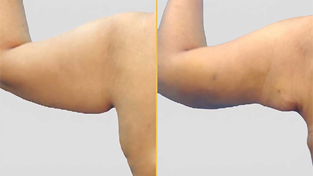 Arm Contouring (Brachioplasty) before and after result - The Hair and Shape Clinic, Mumbai