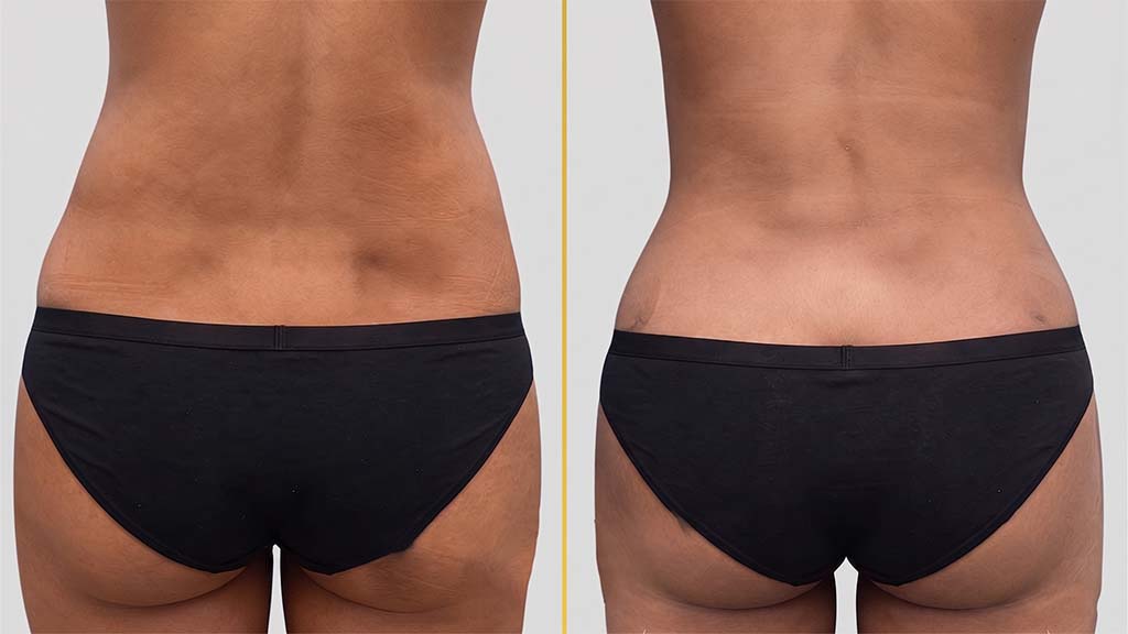 Liposuction before and after result - The Hair and Shape Clinic, Mumbai