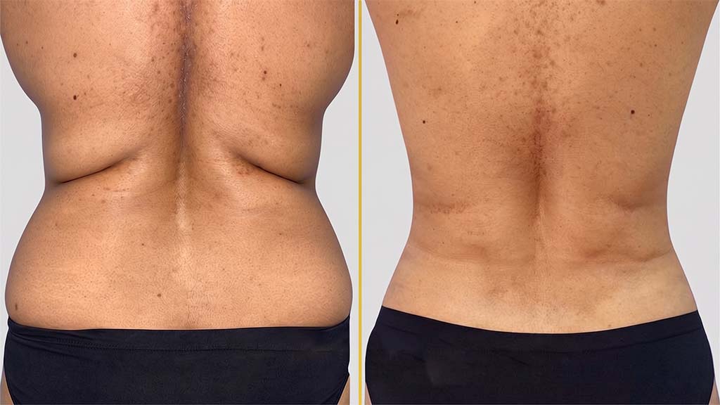 Liposuction before and after result - The Hair and Shape Clinic, Mumbai