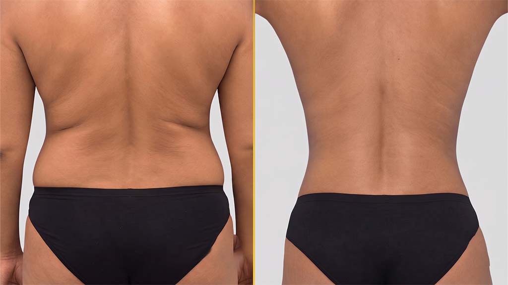 Liposuction before and after result - The Hair and Shape Clinic, Mumbai