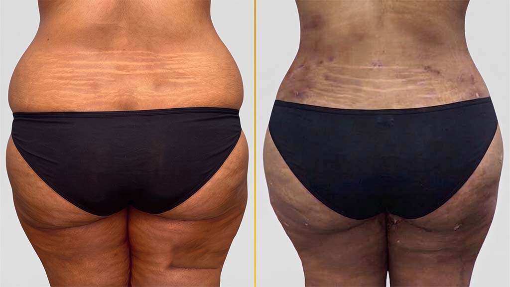 Liposuction before and after result - The Hair and Shape Clinic, Mumbai