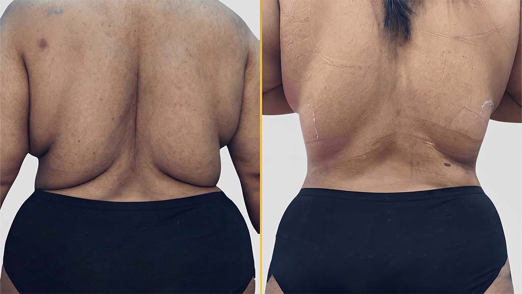 Liposuction before and after result - The Hair and Shape Clinic, Mumbai