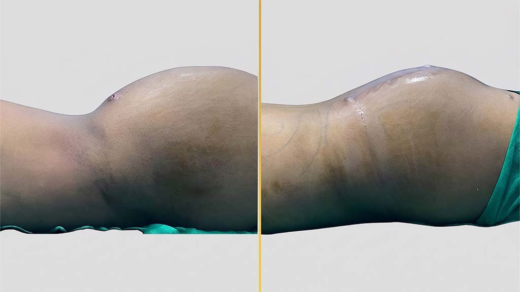 Liposuction before and after result - The Hair and Shape Clinic, Mumbai